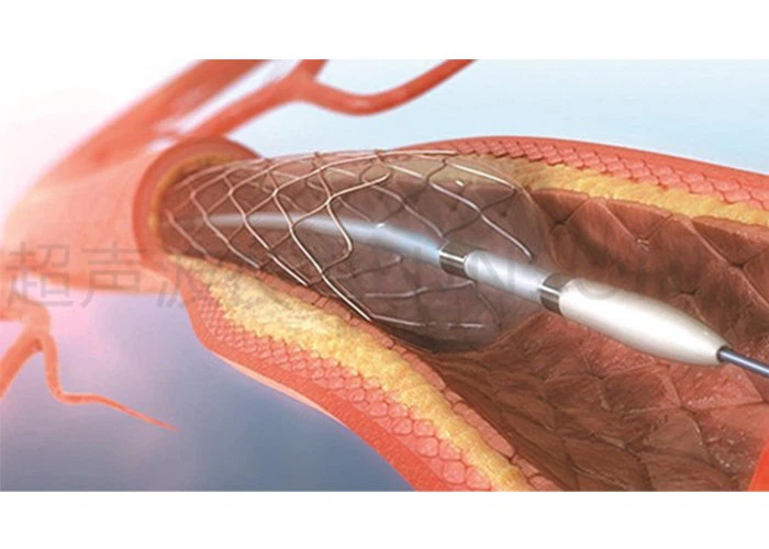 Drug elution balloon catheter ultrasonic spraying 9 Drug elution balloon catheter ultrasonic spraying 9